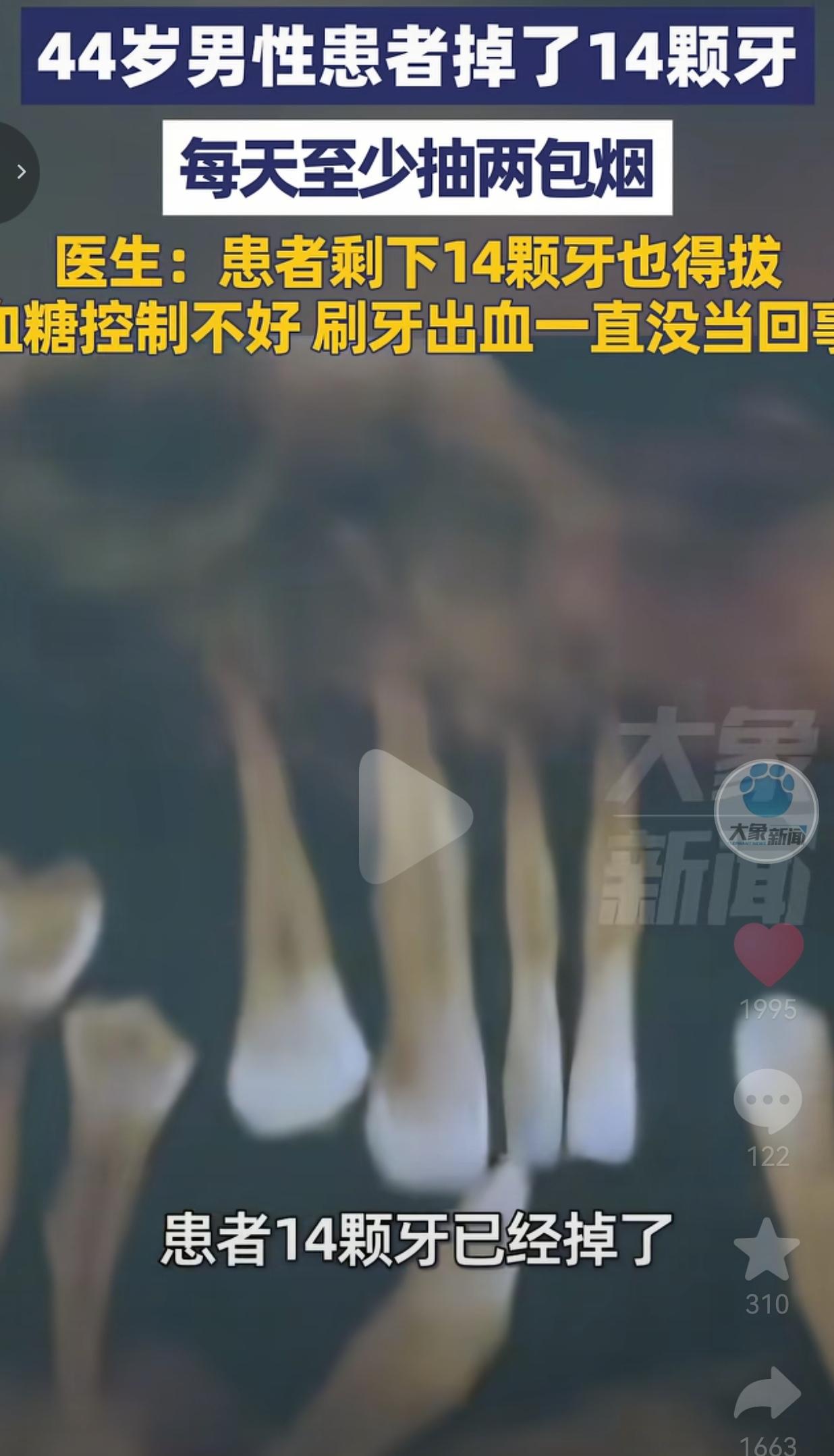 看得头皮发麻！郑州一个44岁的大哥，硬生生把自己一口好牙作没了！28颗牙掉了14