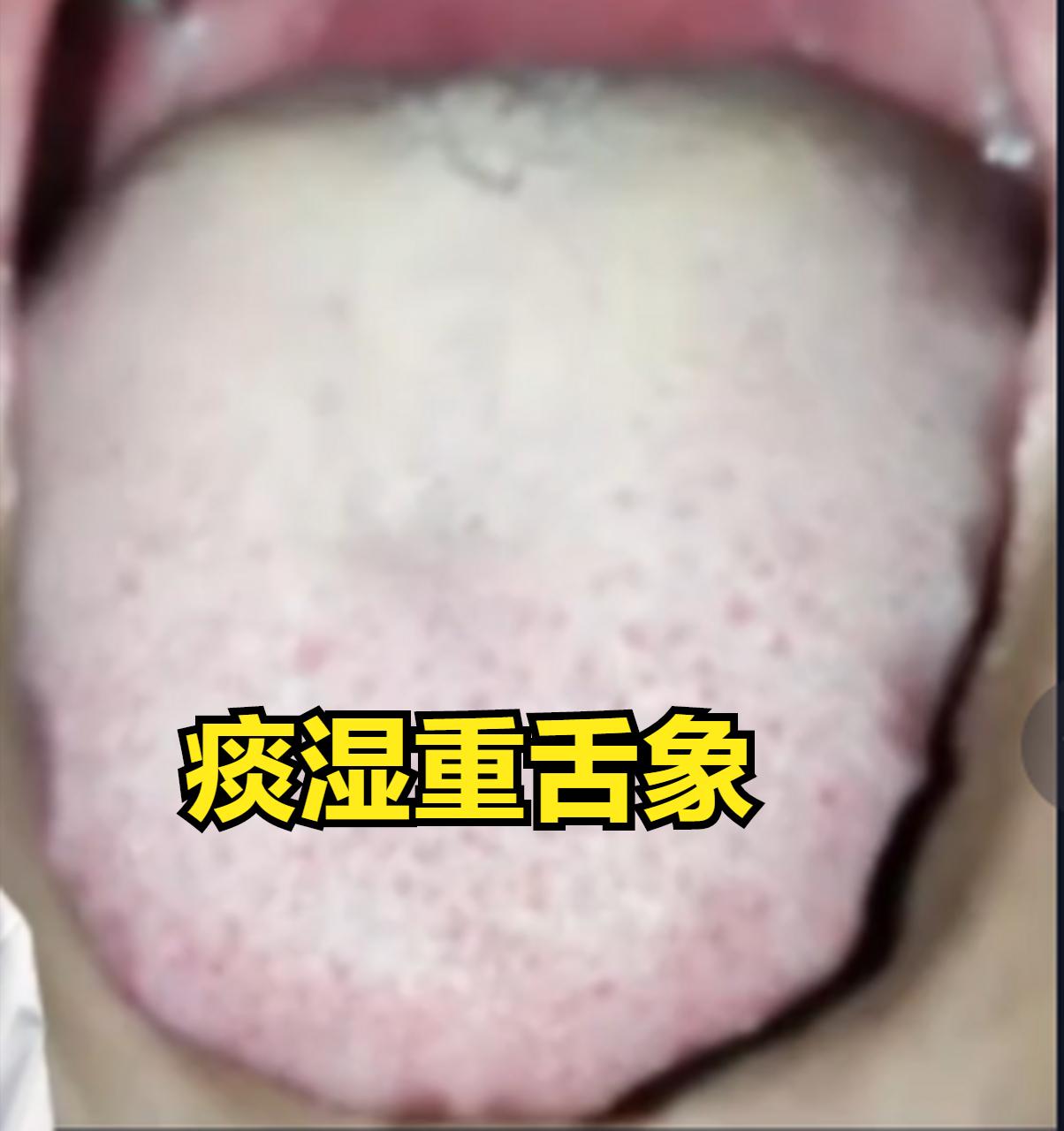 中医祛痰最全名方，建议收藏！

1、寒痰——小青龙汤
表现：咳嗽咳痰，痰液颜色发