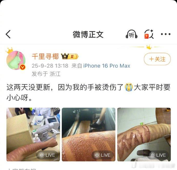 网红千里寻椰去医美机构给手打光子嫩肤，打完之后手开始火辣辣的疼持续了七个小时，去