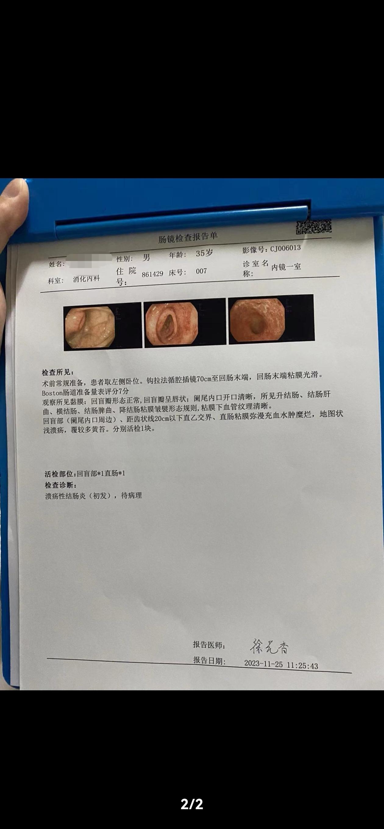 溃疡性结肠炎黏膜愈合的评估需要严格。这位患者，溃结20cm病变，服药5...