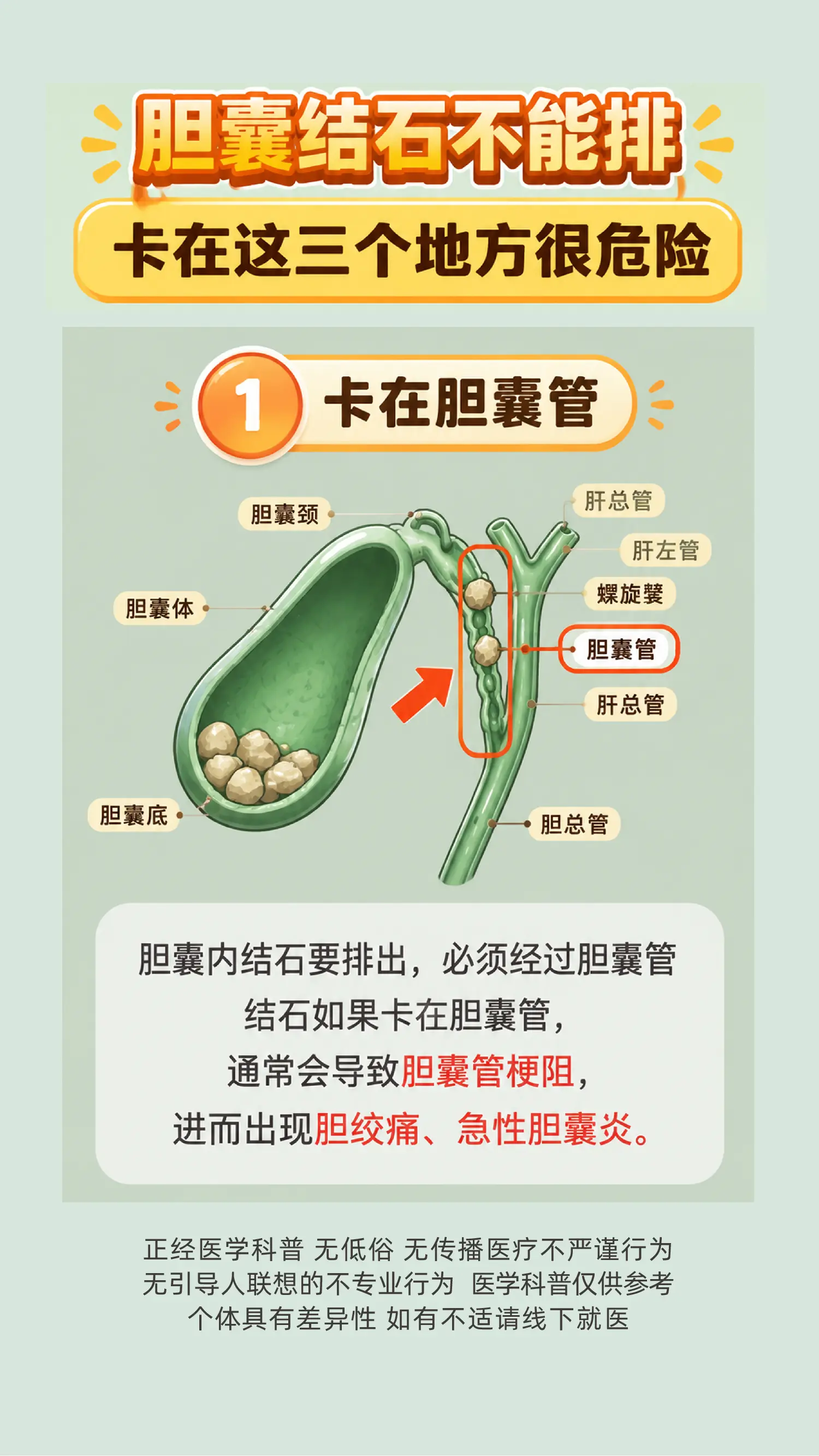 胆囊结石不要盲目排石，卡在这些很危险。