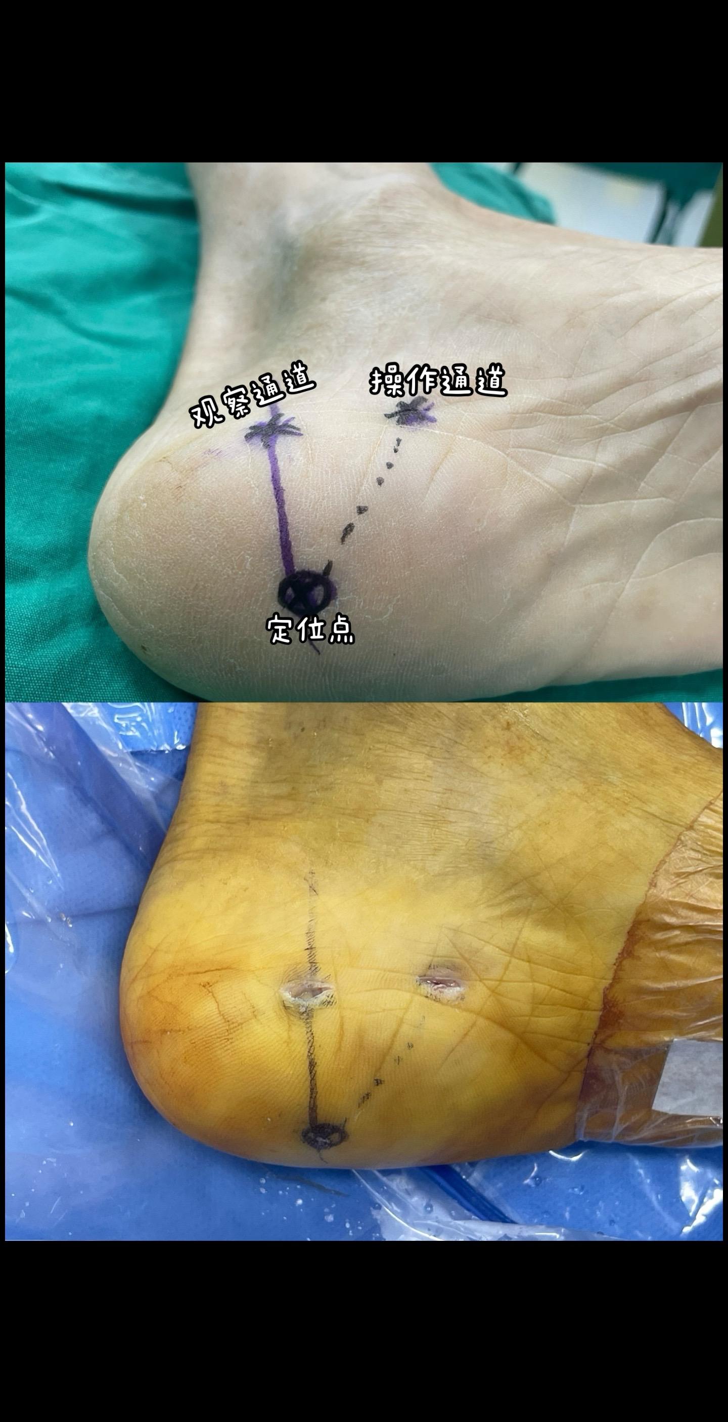 顽固性跟痛症，关节镜下治疗。
