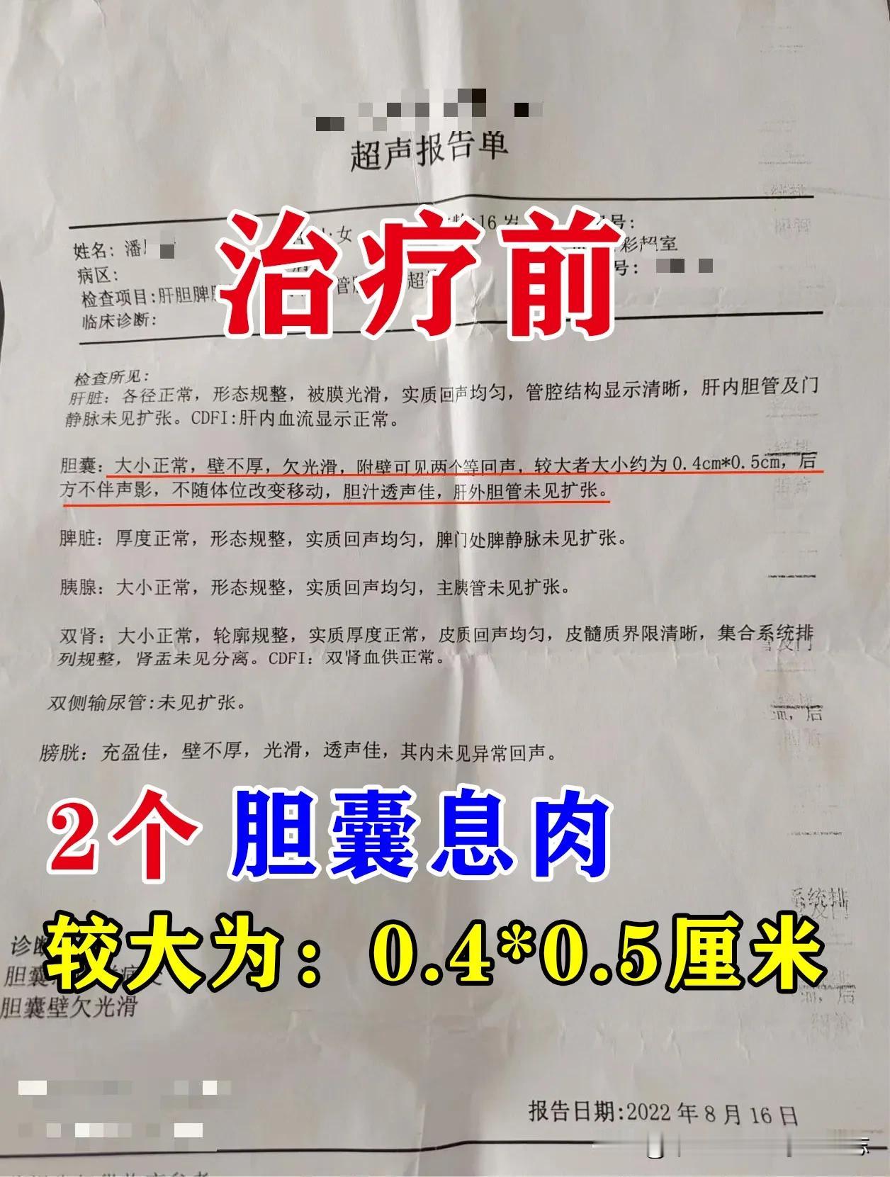 这位患者16岁，女性，体检时发现有胆囊息肉，两个，较大者0.4*0.5cm，胆囊
