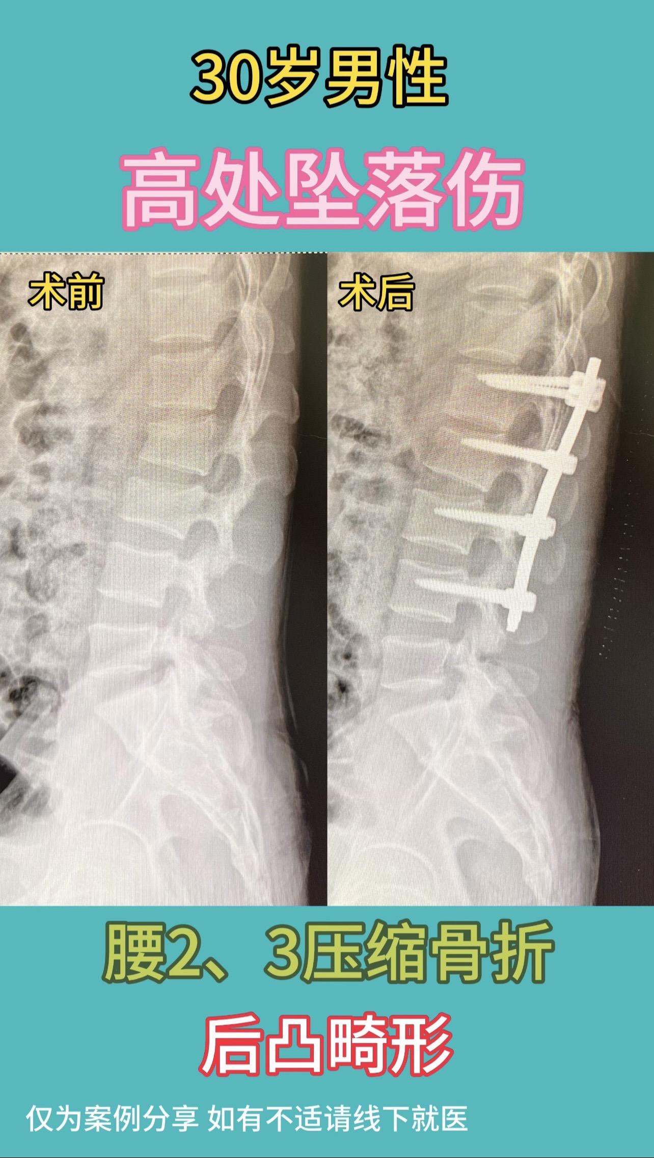 30岁男性，高处坠落伤，导致腰2、3压缩骨折，后凸畸形，术后矫正效果满意！