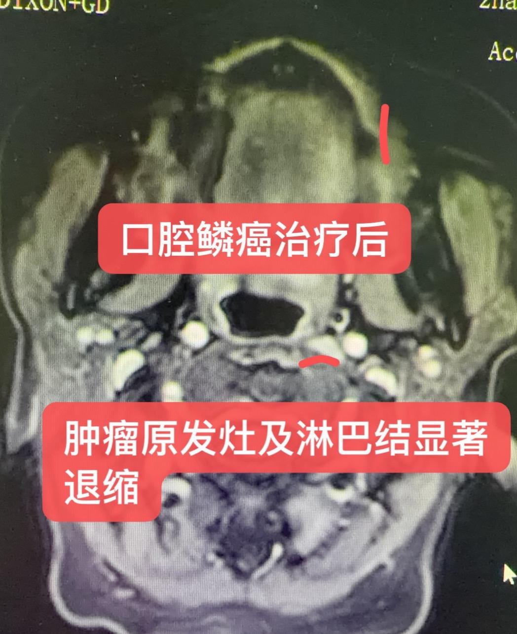 口腔鳞癌的治疗！患者，女，75岁，肿瘤突出于嘴唇，左侧脸部肿胀疼痛，分...