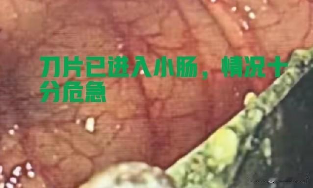 由14岁女孩跟同学吵架后吞3枚刀片说起

近日，陕西西安一14岁女孩儿因与同学吵