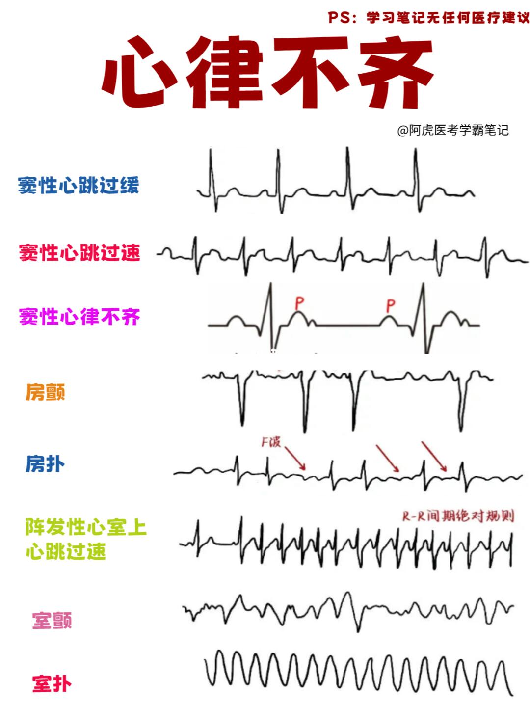 阿虎医考学霸笔记📒：心律不齐👆