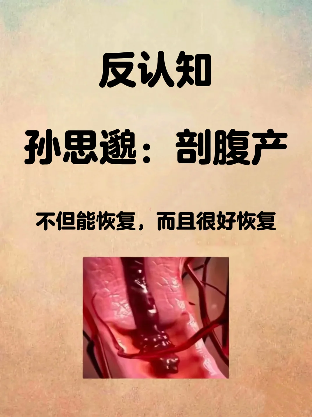 孙思邈：剖腹产不但能恢复，而且还很好恢复