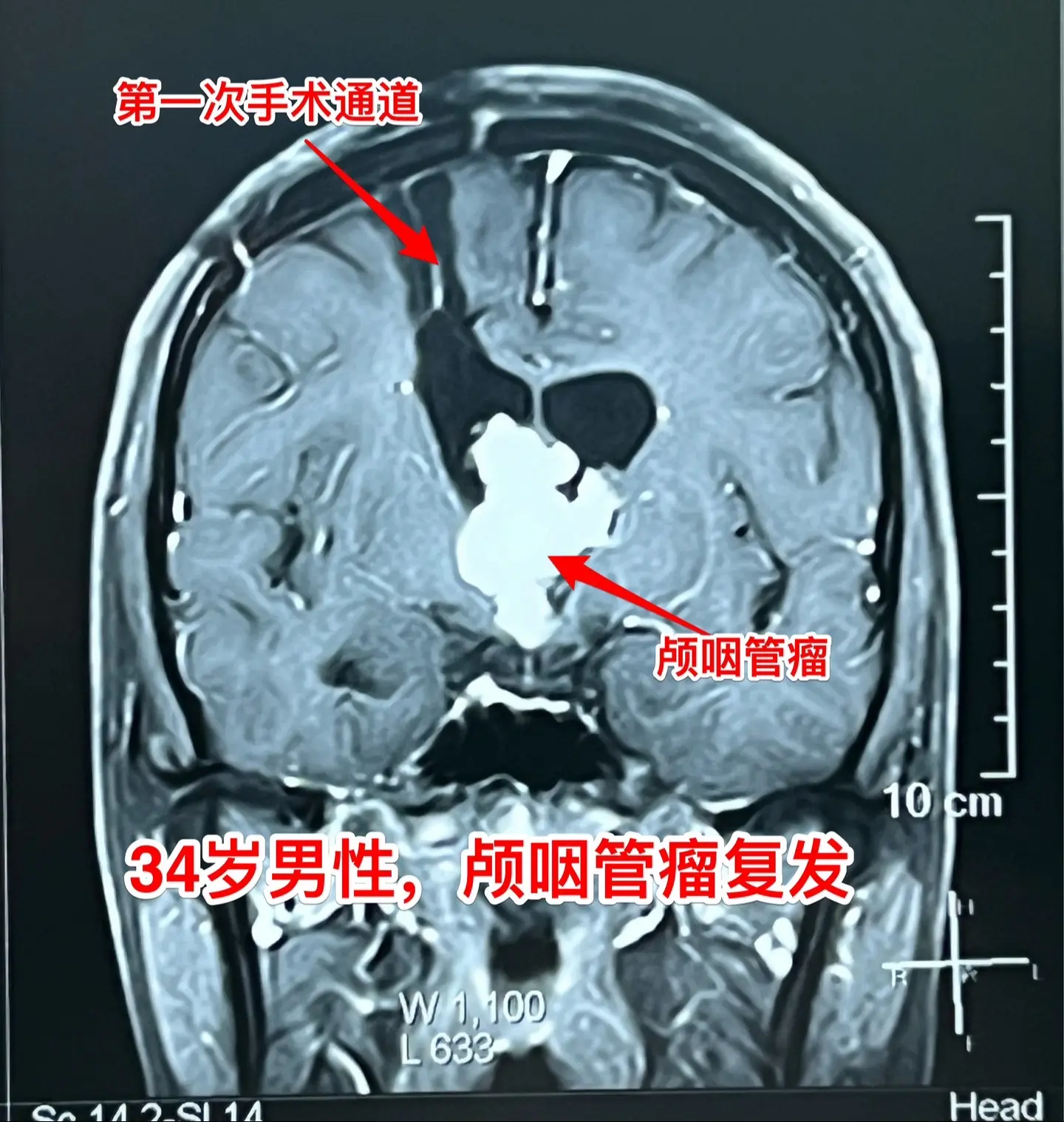 34岁广州男性颅咽管瘤复发。一年前他在广州市某医院行开颅手术切除颅咽管...