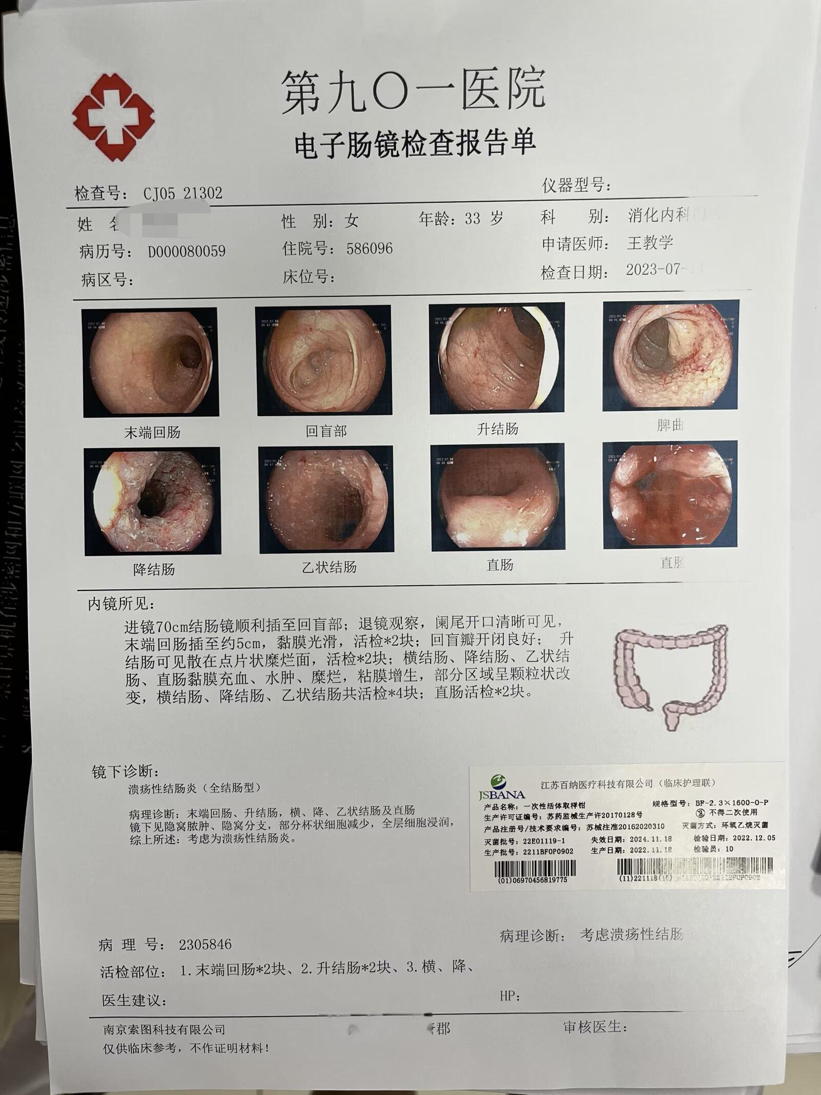 溃疡性结肠炎治疗后肠镜随访是非常重要的。1.肠镜是评估疗效的金标准，而...
