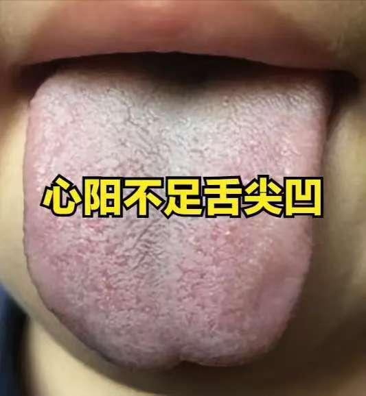 人有三阳：心阳、脾阳、肾阳，三阳都不可或缺！
 
1、心阳不足
症状：心阳不足时