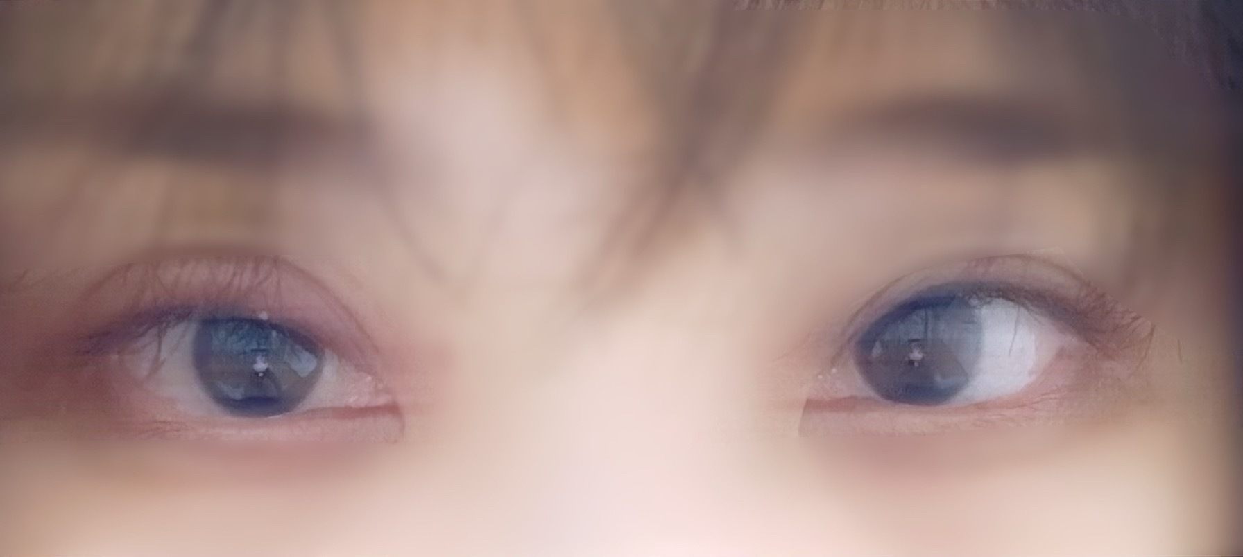 看我的麦粒肿，两眼睛已经不是一对了