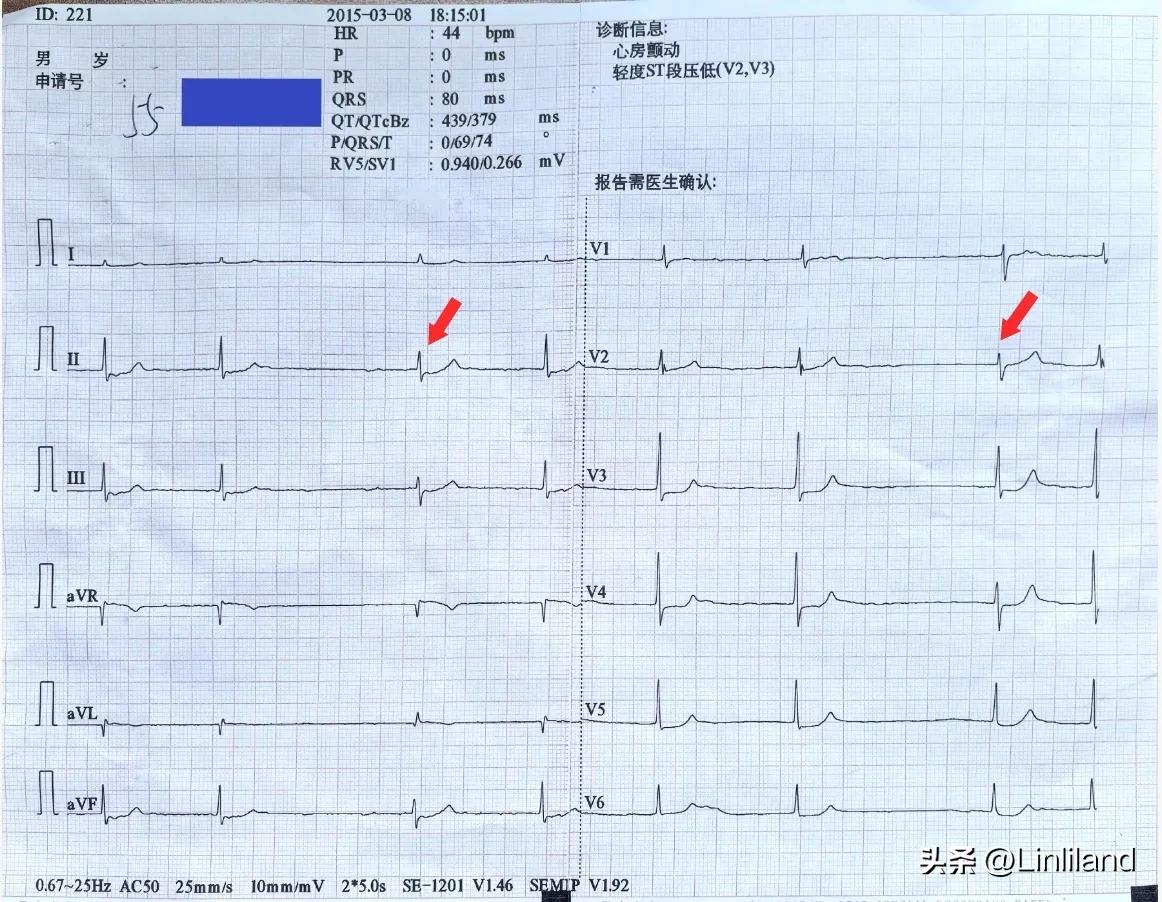 对于大多数专业医生来说，这幅“房颤”的心电图诊断并不难，而且，也会注意到“下壁及