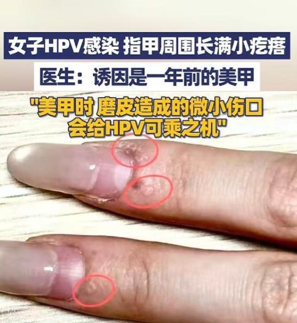[下雨]5月9号报道，杭州萧山一名年轻女子做完美甲的手上竟长满“小疙瘩”，一查竟