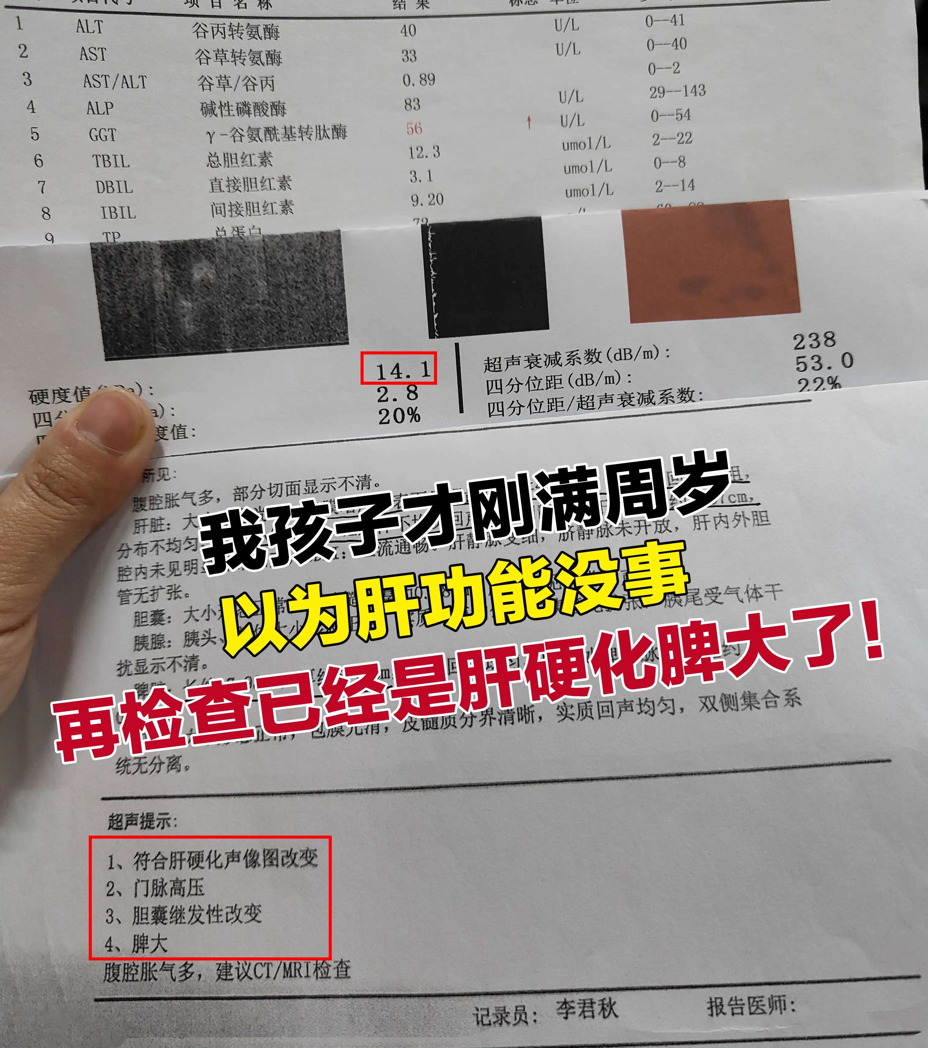 你也以为肝功能正常肝脏就没事了吗？。刚看到这位姑娘的化验单，真的很揪心...