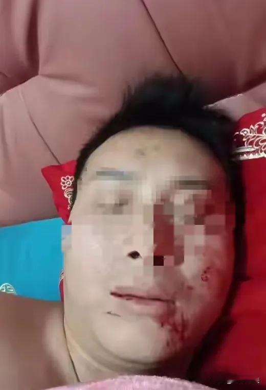 38岁好不容易讨个老婆，婚礼办得风风光光，结果洞房夜脸就被新娘抓花了。新娘说是“