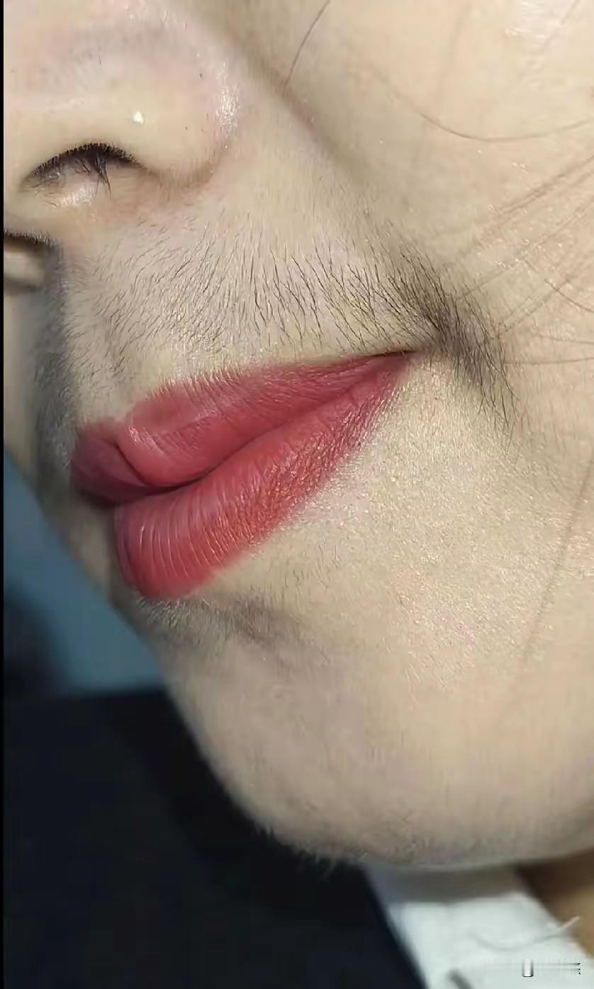 哎妈呀，平时就知道闺蜜胡须重，没想到放大了看这么吓人。这是雄性激素过多吗？
我们