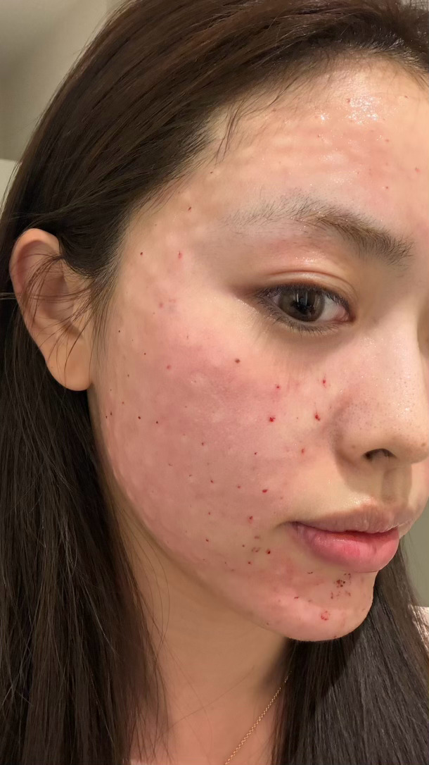 我也是做过大大小小不计其数的医美了这个韩国真把我痛死了打丽珠兰的红盒其实我觉得并