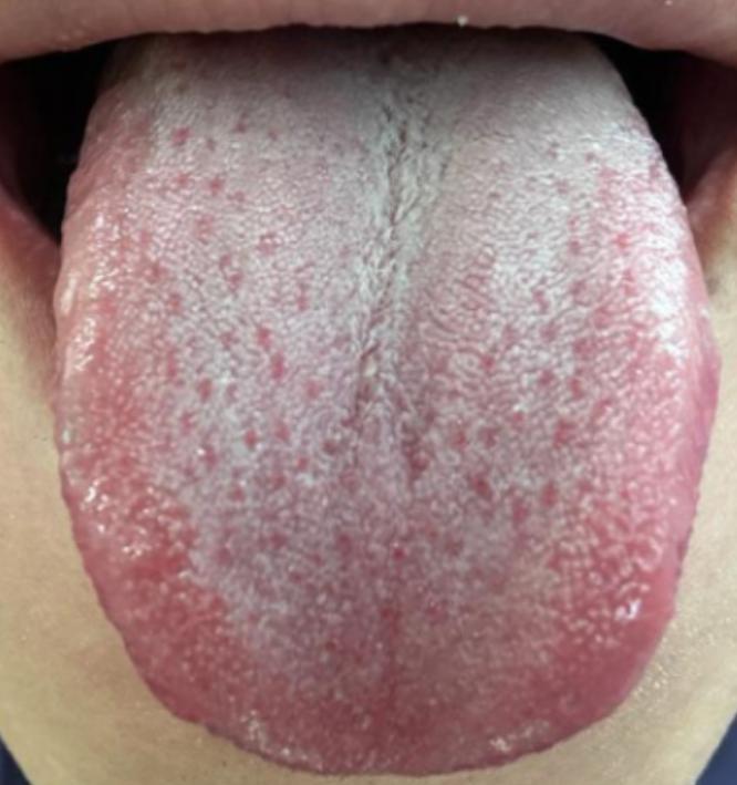 这种舌边红点，90%的人都会误认为是肝火，盲目泻火只会南辕北辙，越清肝越疲惫！