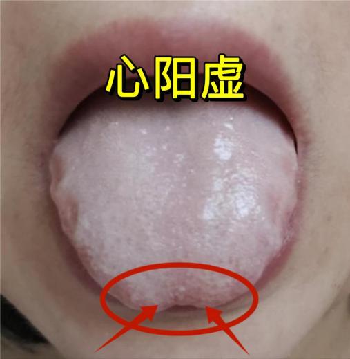参附强心丸对应的“心肾阳虚，水湿内停症”舌象及辨证解析
中医认为“心主血脉、肾主