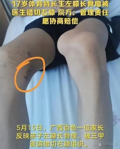离了大谱！广西百色，一位17岁体育生左膝长骨瘤，家长带着孩子来到一家三甲医院治疗