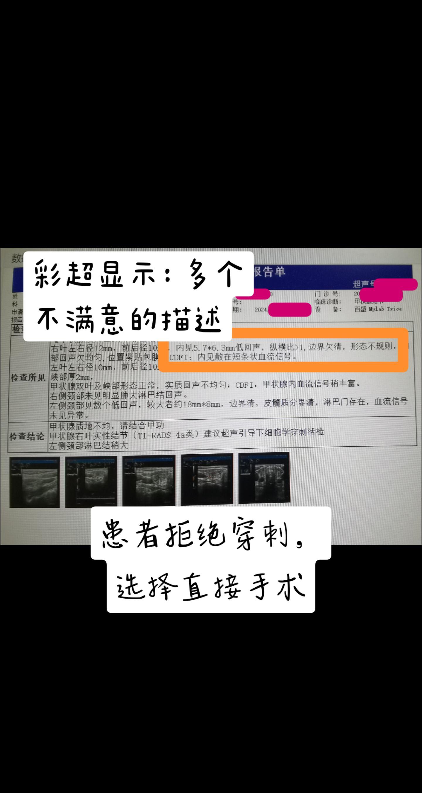 甲状腺癌消融，需谨慎！2月前，一位女士甲状腺结节来门诊咨询，彩超报告分...