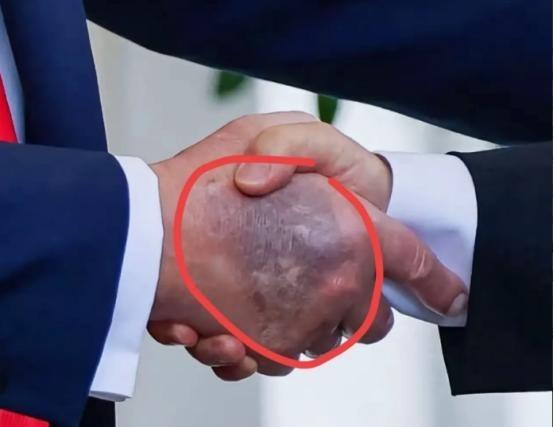 特朗普在白宫会见李在明，被记者拍到手背乌黑淤青，最初面积小时还涂遮瑕膏，现在面积