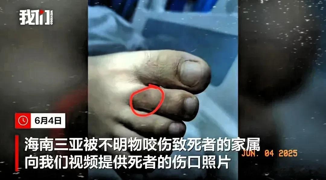 三亚被蛇咬死的美女真冤！
三亚被蛇咬伤女游客的伤口照片曝光，被咬到的是右脚第二根