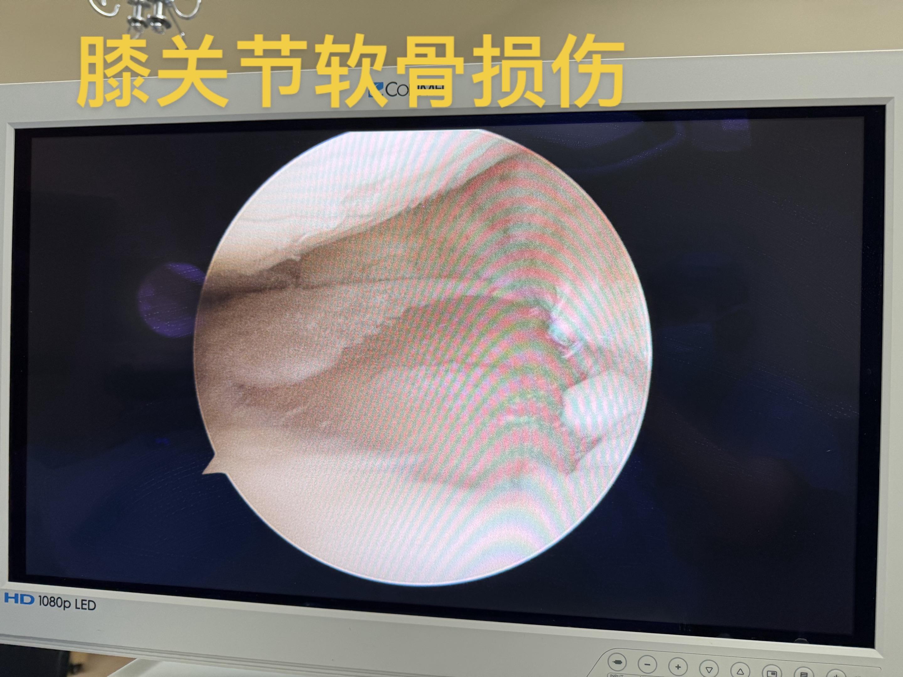 膝关节软骨损伤怎么办？ PRP治疗效果显著