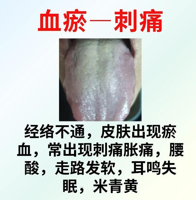 中医舌诊辨证6种体质！