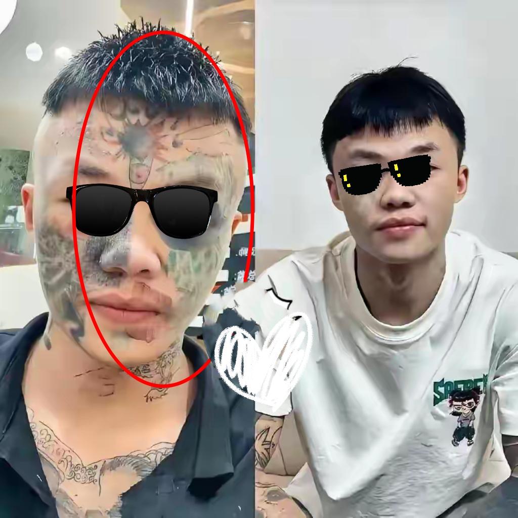 广东男孩夏朝勇的脸，已经挨了三次激光了！再熬两次，13岁那年纹的图案就能彻底没了