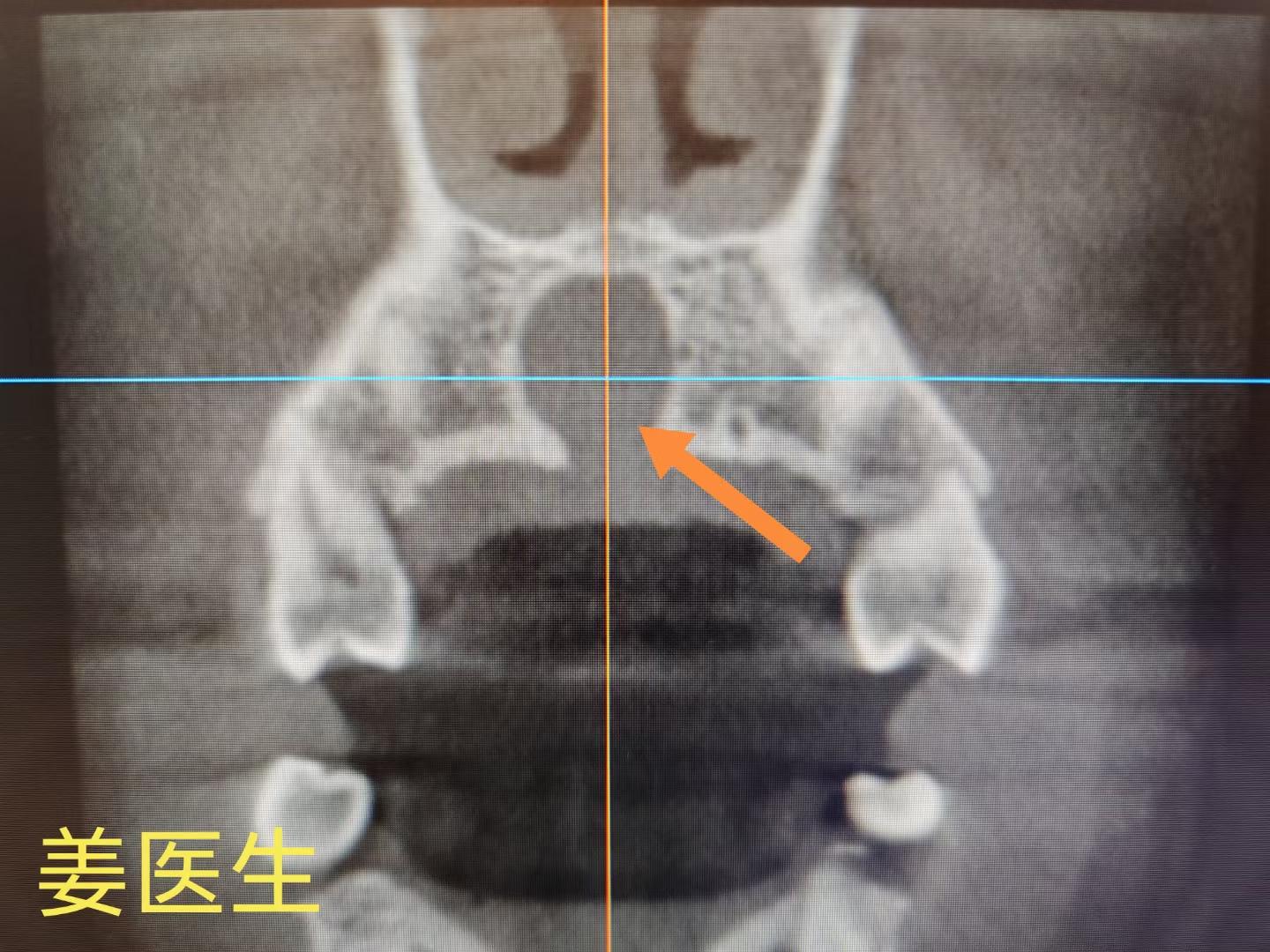 鼻鄂囊肿。鼻腭管囊肿又名鼻腭囊肿，切牙管囊肿、正中腭囊肿和正中前上颌囊...