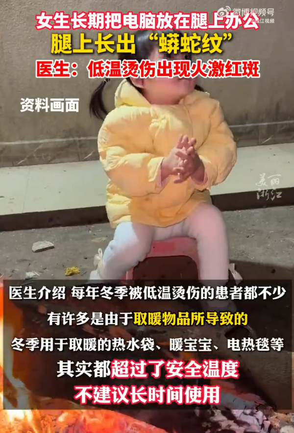 女生长期把电脑放腿上办公长出蟒蛇纹  这不就相当于低温慢煮牛排那样了吗？ 笔记本