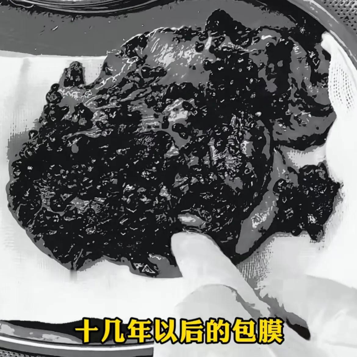 手术取出一侧乳房内像“癞蛤蟆