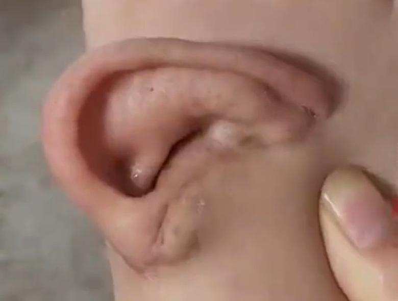 近日，山东济南市将左耳寄养在脚上5个月的孙女士，终于等到了“耳朵回家”。今年4月