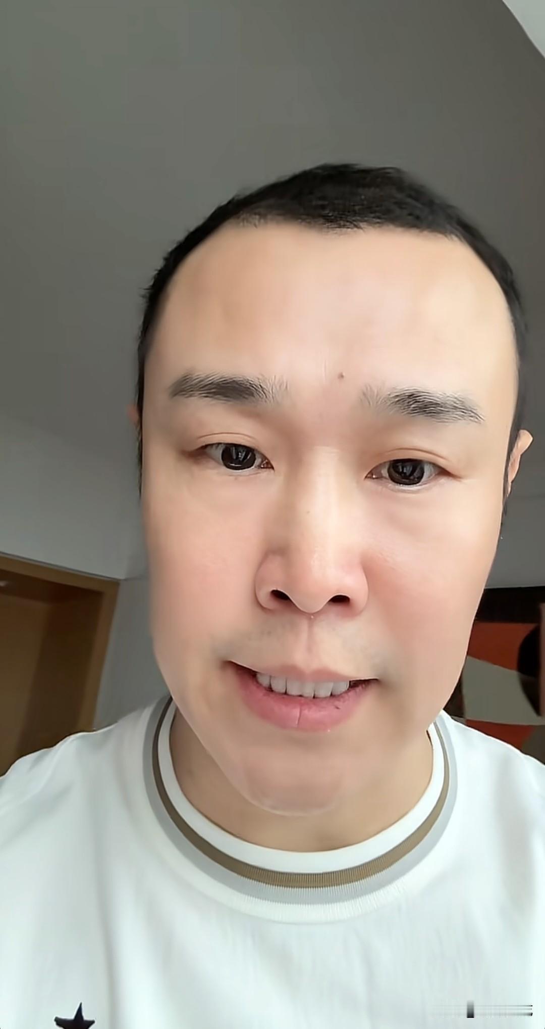 8月7日，小沈阳更新视频。视频里他没有戴假发，极短的寸头，发际线后移明显，两鬓发