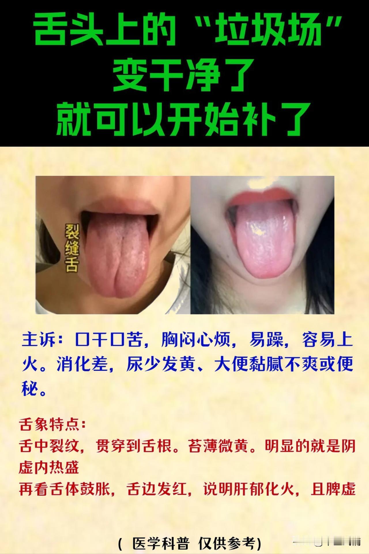 舌诊案例：裂缝舌
患者主诉：口干口苦，胸闷心烦，易躁，容易上火，消化差，尿少发黄