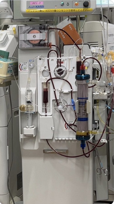 美国新冠疫苗后遗症患者在日本江户川医院接受血浆交换疗法后奇迹般恢复从血液中去除棘