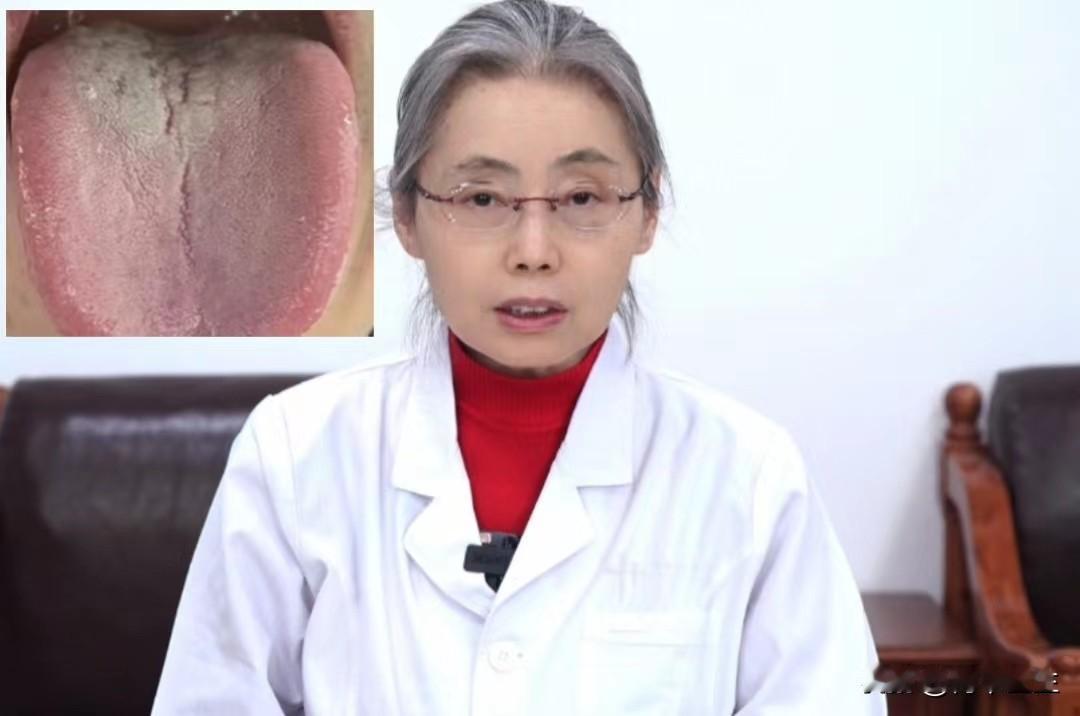 这种厚腻苔，裂纹舌，再不节制，就很难调了！

主诉：宗筋萎软，阴囊潮湿，腰膝酸软