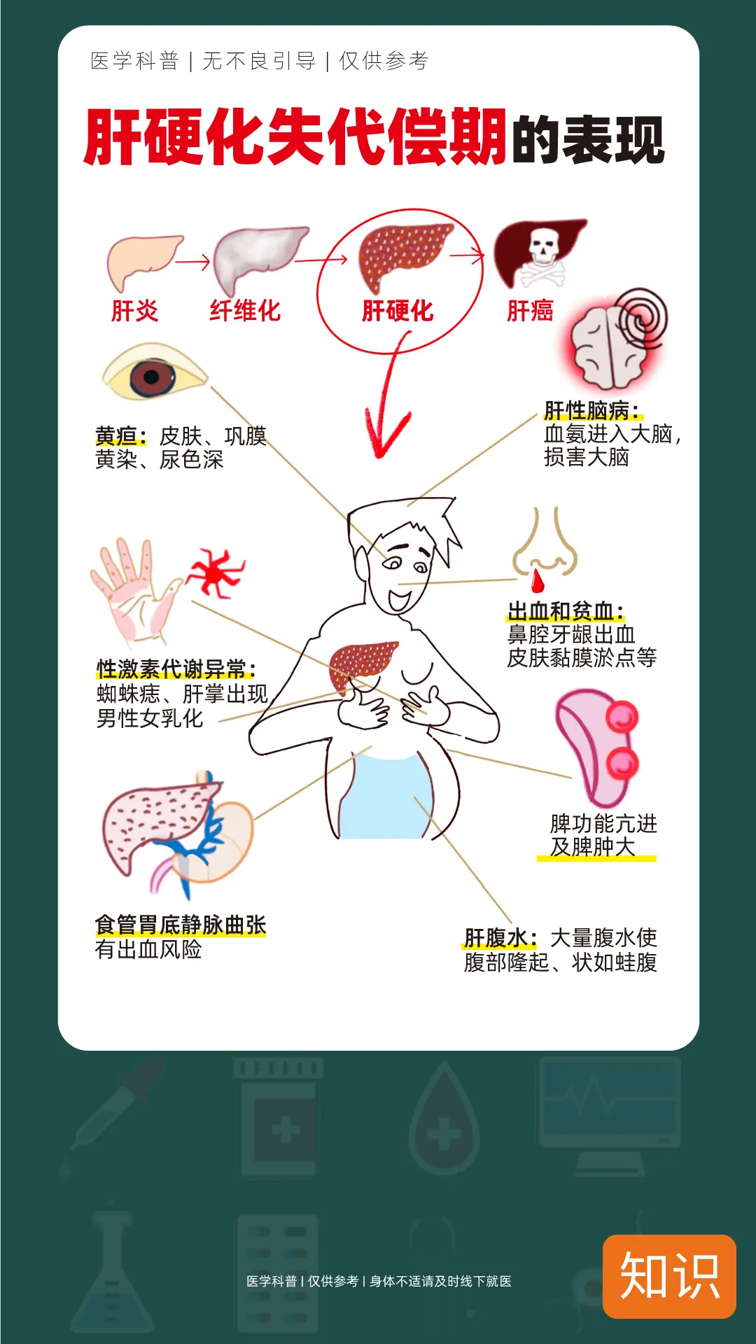 肝硬化失代偿期的表现，看看你有吗！