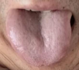 一吃油腻就拉肚子还腰膝发软？多半是脾肾阳虚，寒湿瘀滞要重视






有位粉丝
