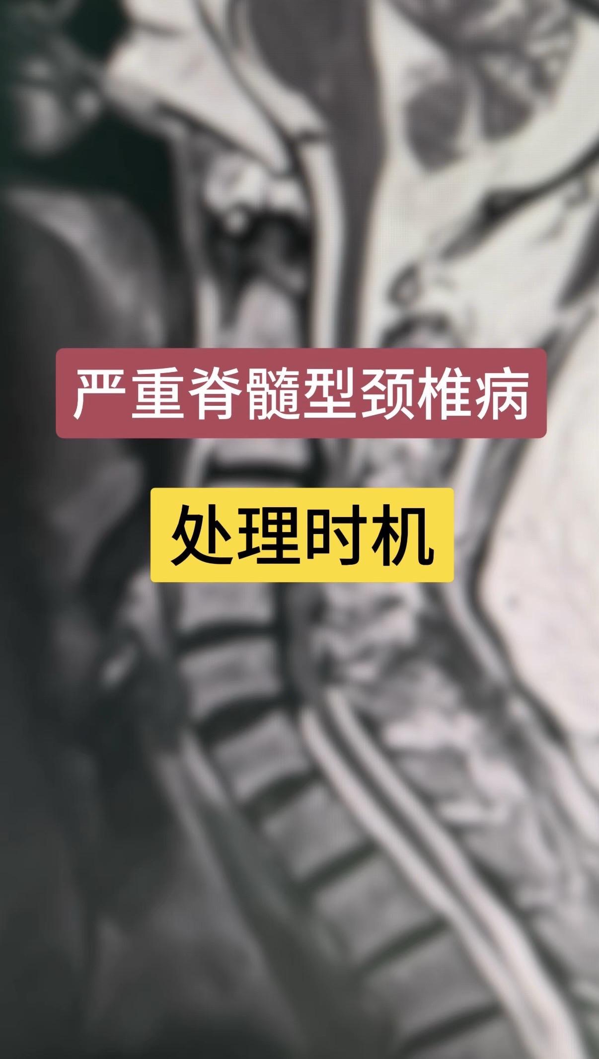 严重脊髓型颈椎病处理时机？60岁女性，四肢无力1年，下肢重，加重3月...
