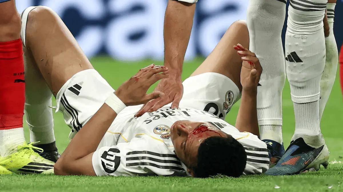 皇马前锋姆巴佩在对阵吉罗纳的比赛中，右眉骨遭对方球员维托尔 - 雷斯肘击致伤口缝