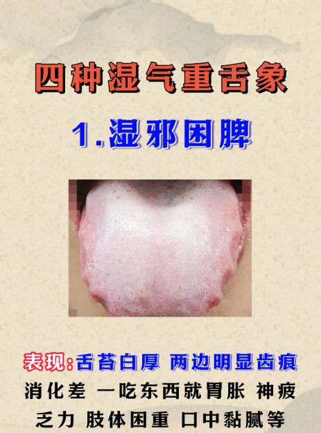 湿气重不重，看舌头就懂！四种舌象对照自测