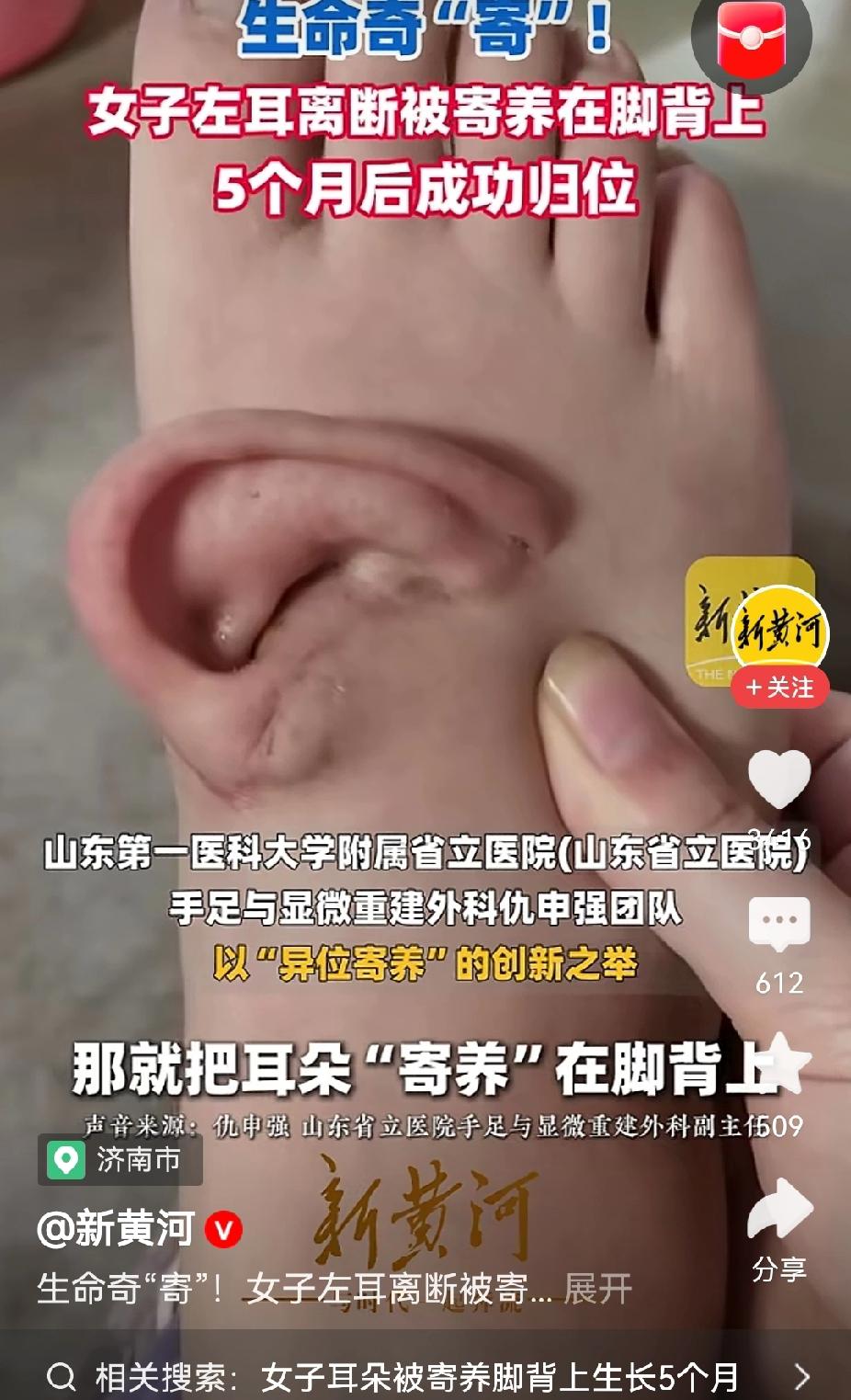 济南医疗也太牛了吧，居然玩起了邪修，把耳朵移植到脚丫上。


事情是这样的：五个