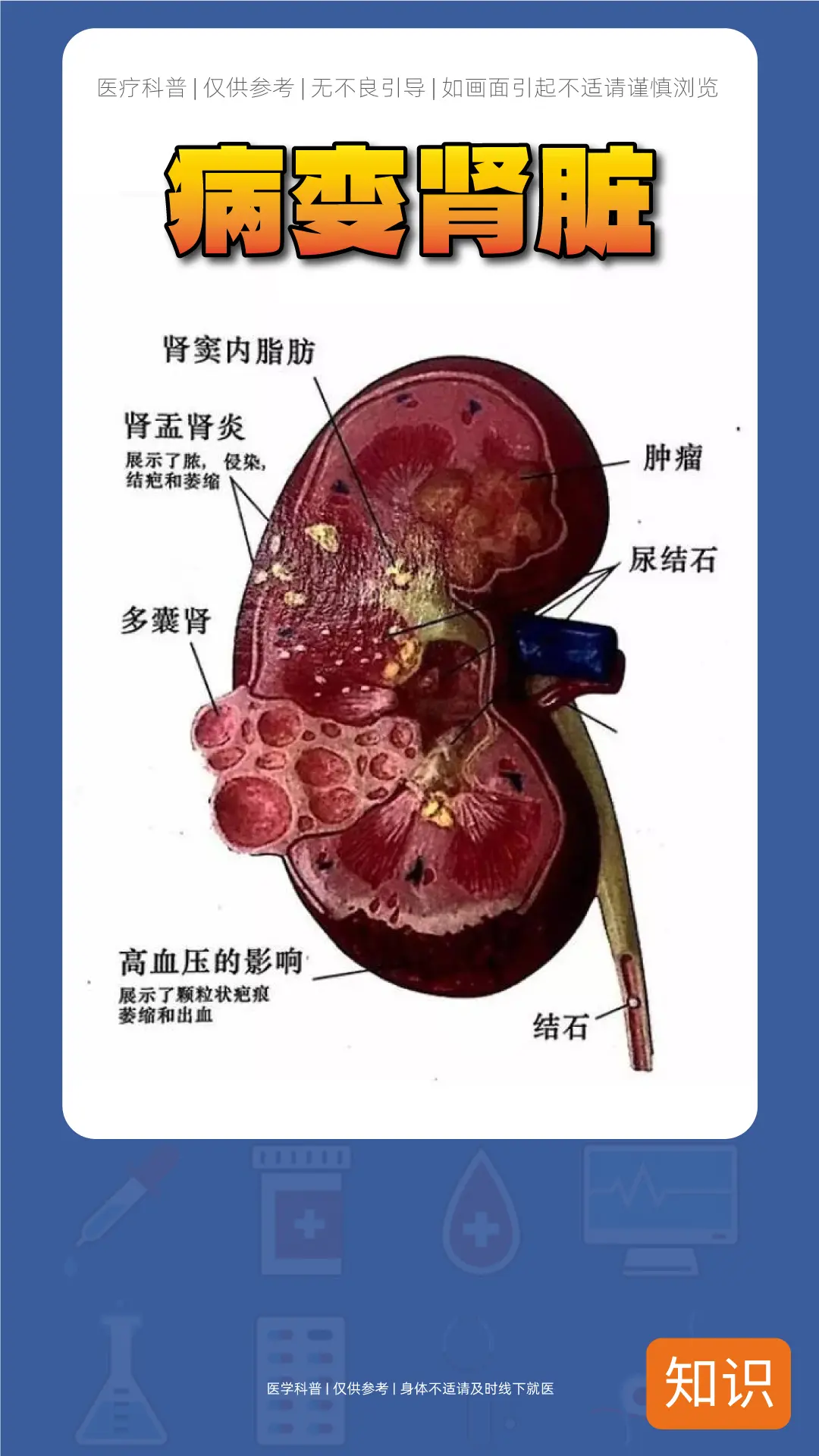 病变肾脏长这样！？