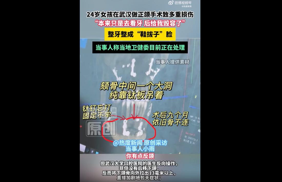 近日，武汉女子小雨遭遇到一个糟心就医经历。
早前小雨因拔牙留下轻微颌面小问题，正