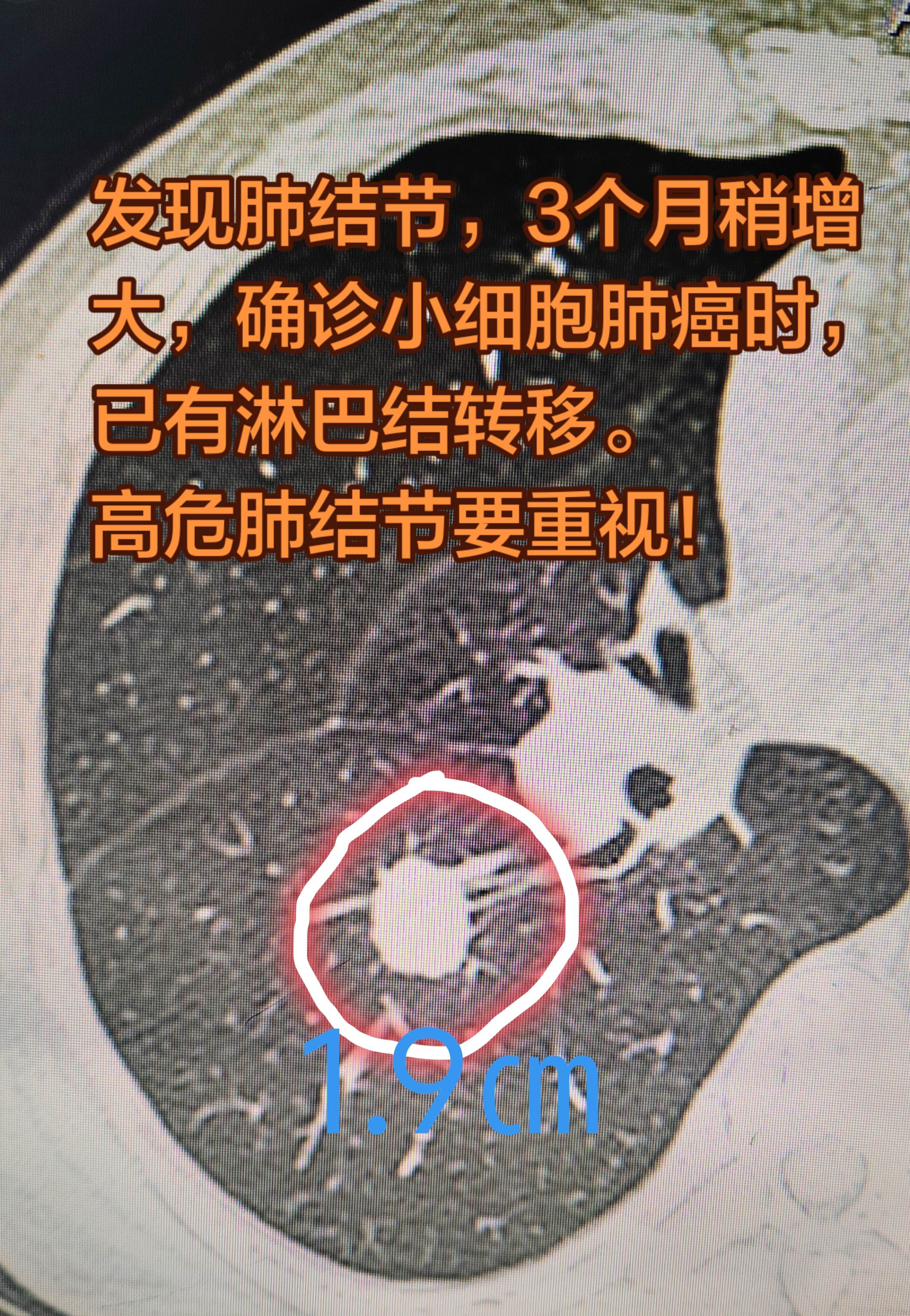 高危实性肺结节，一定要重视。一男性吸烟病人，因其他原因行非胸部手术治疗...