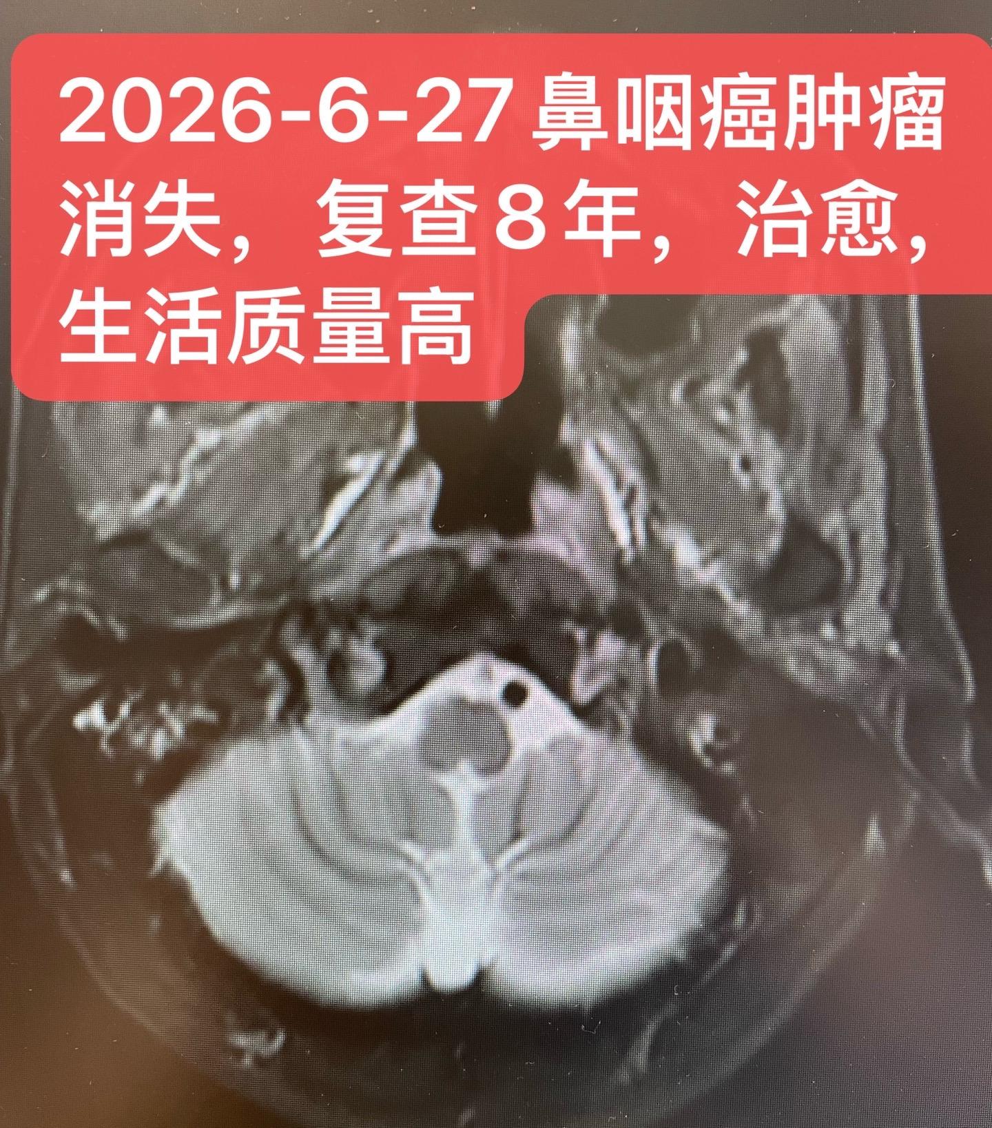 局部晚期鼻咽癌治愈：复查8年无肿瘤。患者，男，66岁，高血压病史。20...