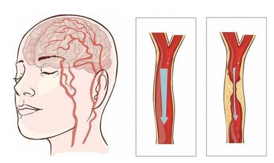 为何中国脑梗越来越多？提醒：离不开这2个祸根，不是叶酸补少了


中国脑梗患者已